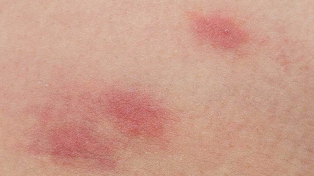 Allergies
