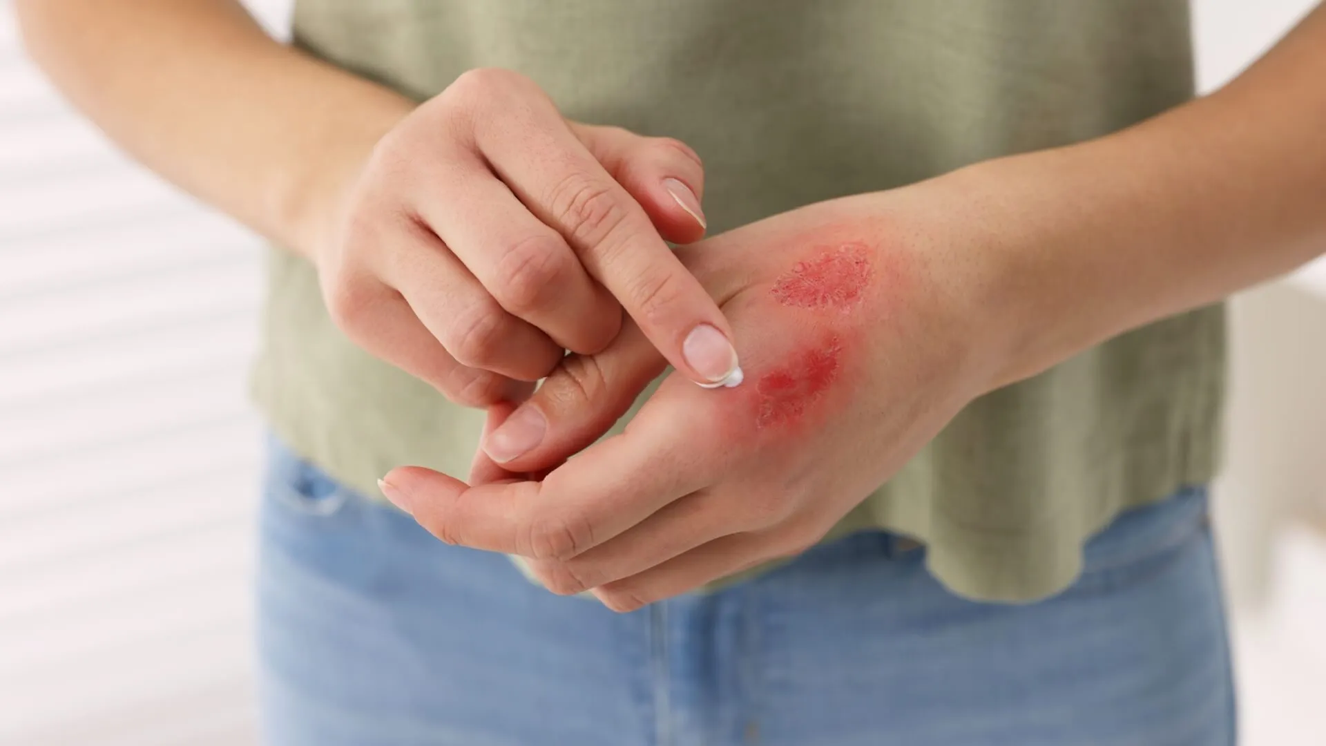 First Degree Burn