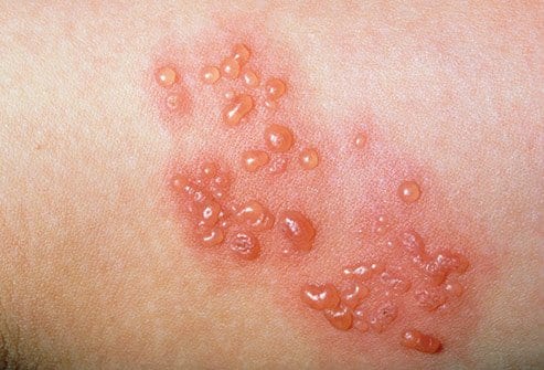 SHINGLES