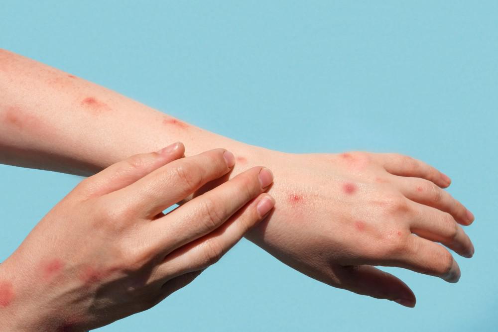 What You Should Know About Monkeypox